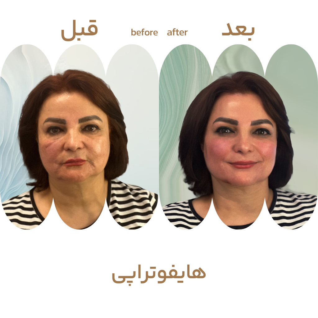 نمونه کار هایفو تراپی